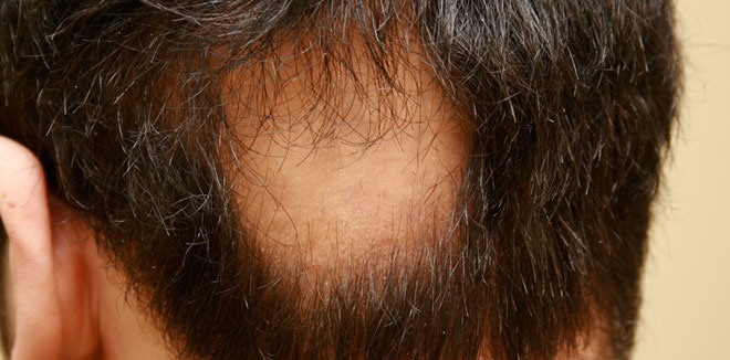 alopecia-hair-loss