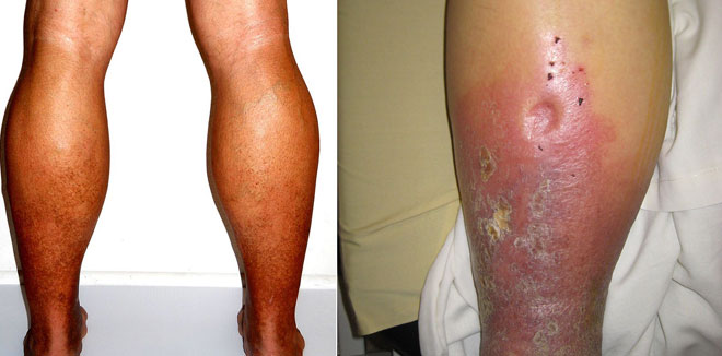 Skin-Changes-Associated-with-Varicose-Veins