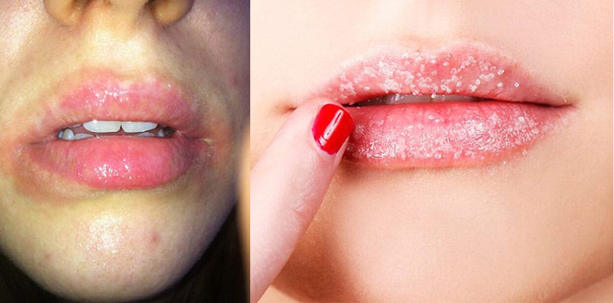 lip-balm