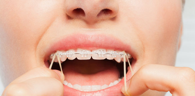 Close-up of woman wearing orthodontic elastic band