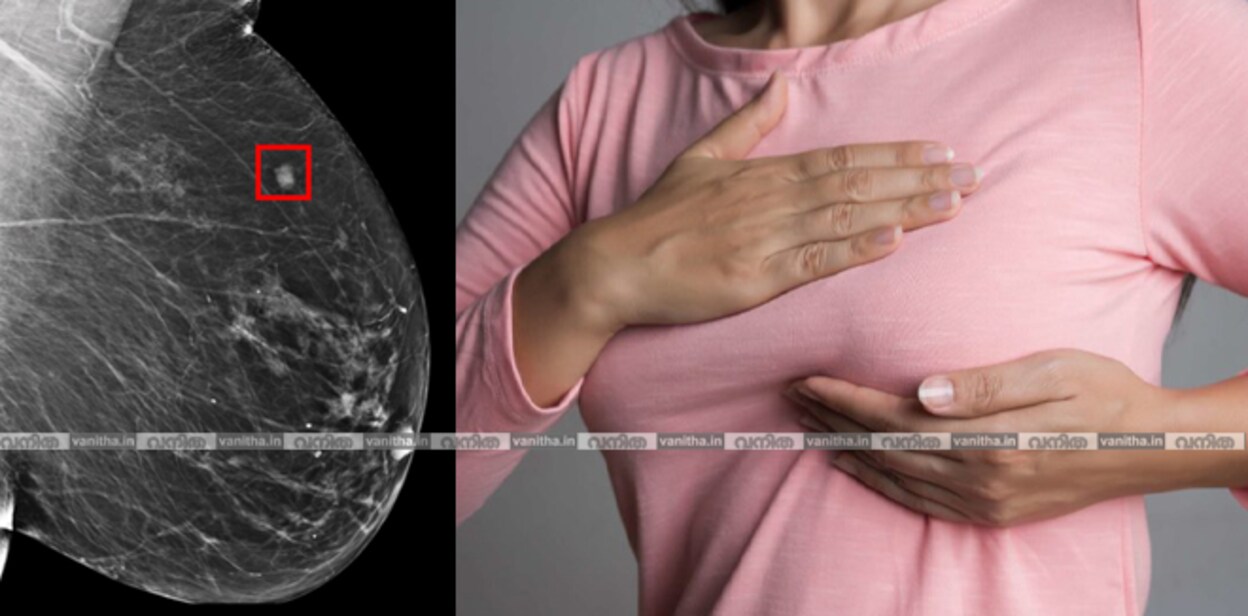 mammogram664ex