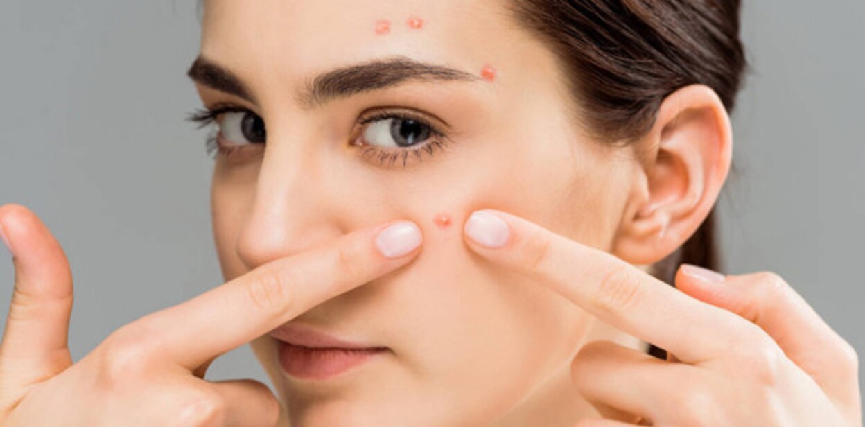 stock-photo-young-woman-acne-touching-face