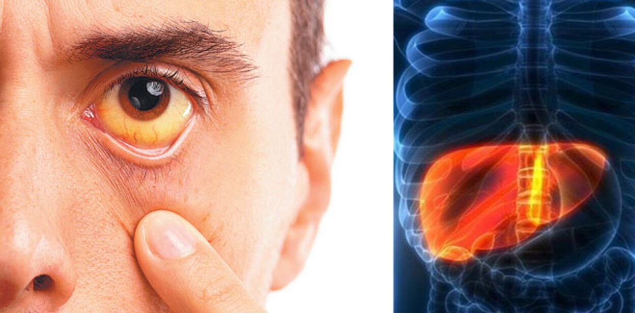 hepatitis