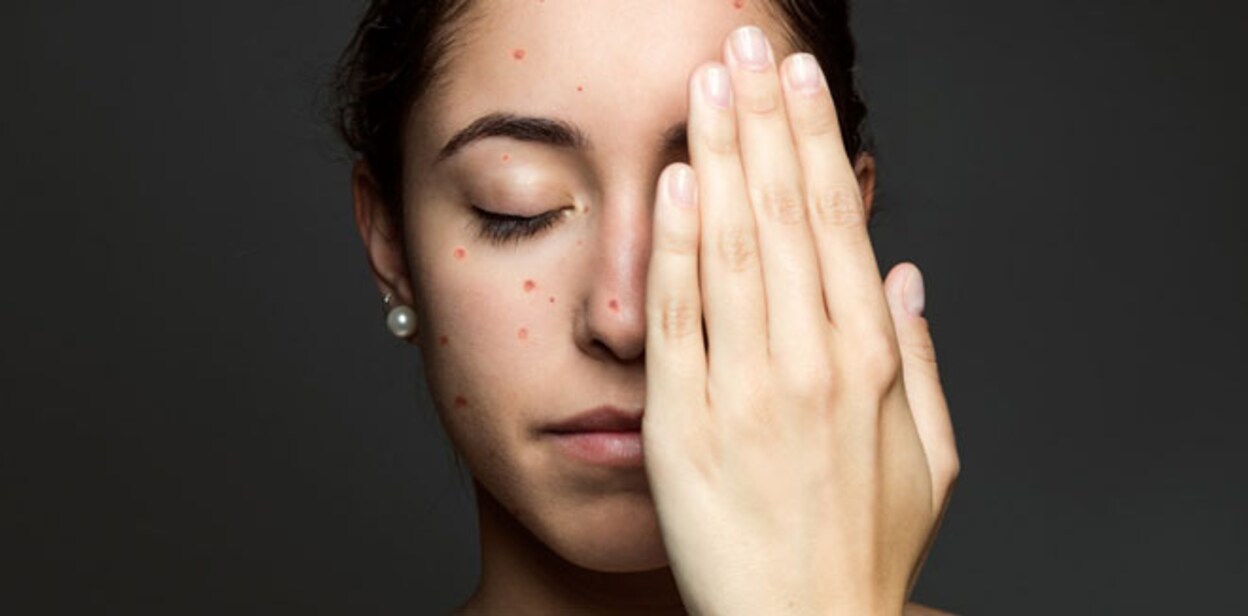 chicken-pox-scar-removal-1