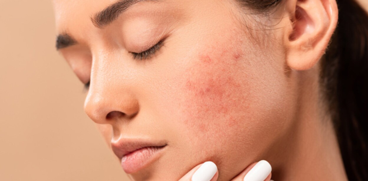 young woman with closed eyes touching face with acne isolated on beige