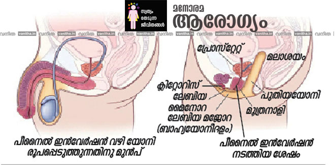 gender-affirmation-male-to-female-surgery-swatham-thedunna