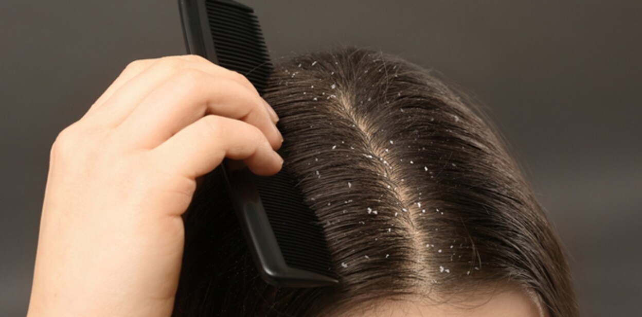 dandruff