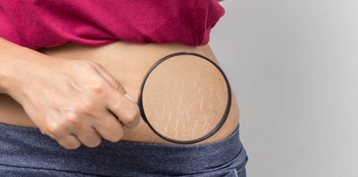 Women Show off the belly after birth. Stretch Marks on white background