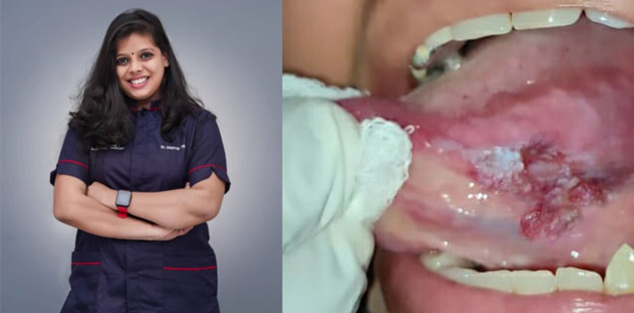 oral-cancer