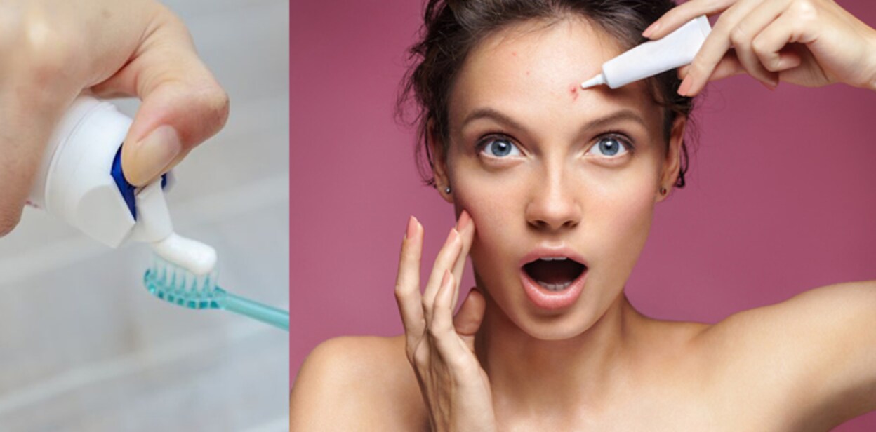 tooth-paste-pimple
