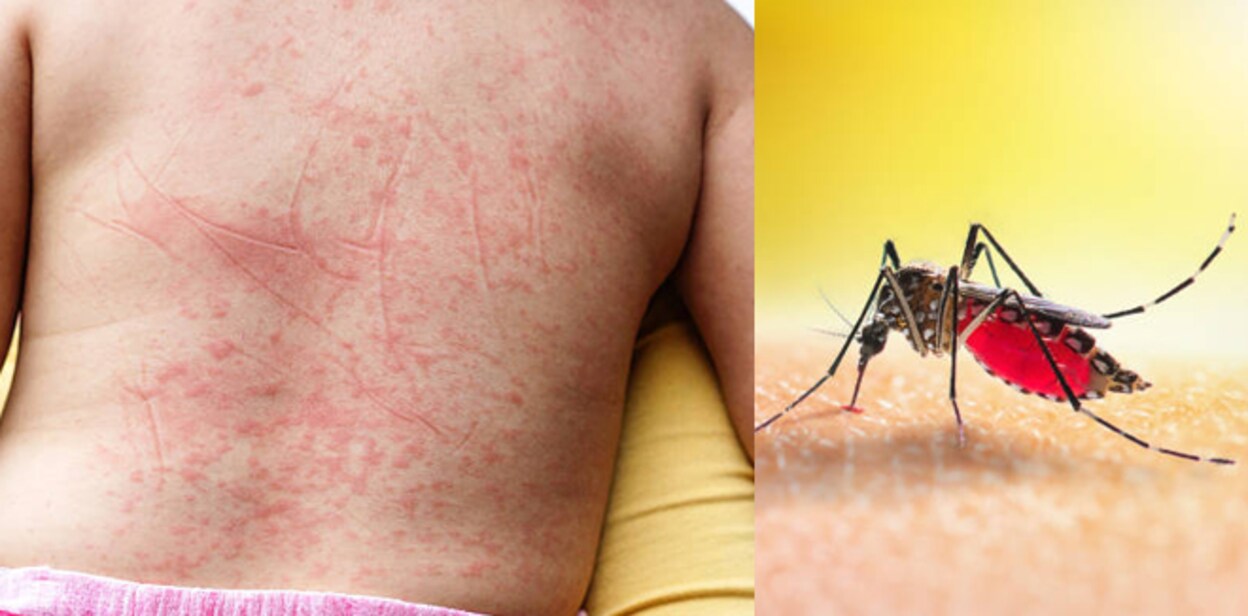 dengue-fever45566000