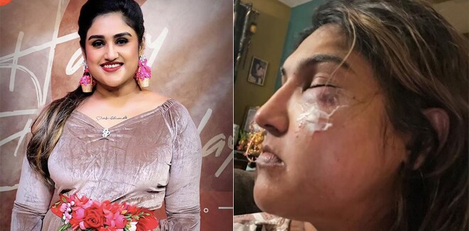 അക്രമി അജ്ഞാതൻ, പിന്നിൽ ബിഗ് ബോസ് പകയോ?: നടി വനിത വിജയകുമാറിനു നേരെ ആക്രമണം: ചിത്രം പങ്കുവച്ച് താരം