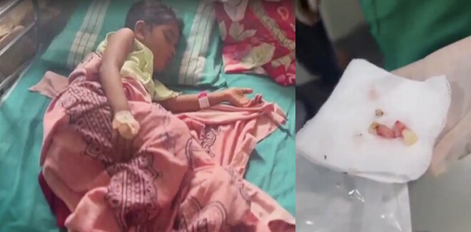 മൂക്കിലെ ദശ മാറ്റാന്‍ ശസ്ത്രക്രിയ; ആറു വയസുകാരിയുടെ മുന്‍വശത്തെ രണ്ടു പല്ലുകള്‍ കൂടി പറിച്ച് ഡോക്ടർമാര്‍!