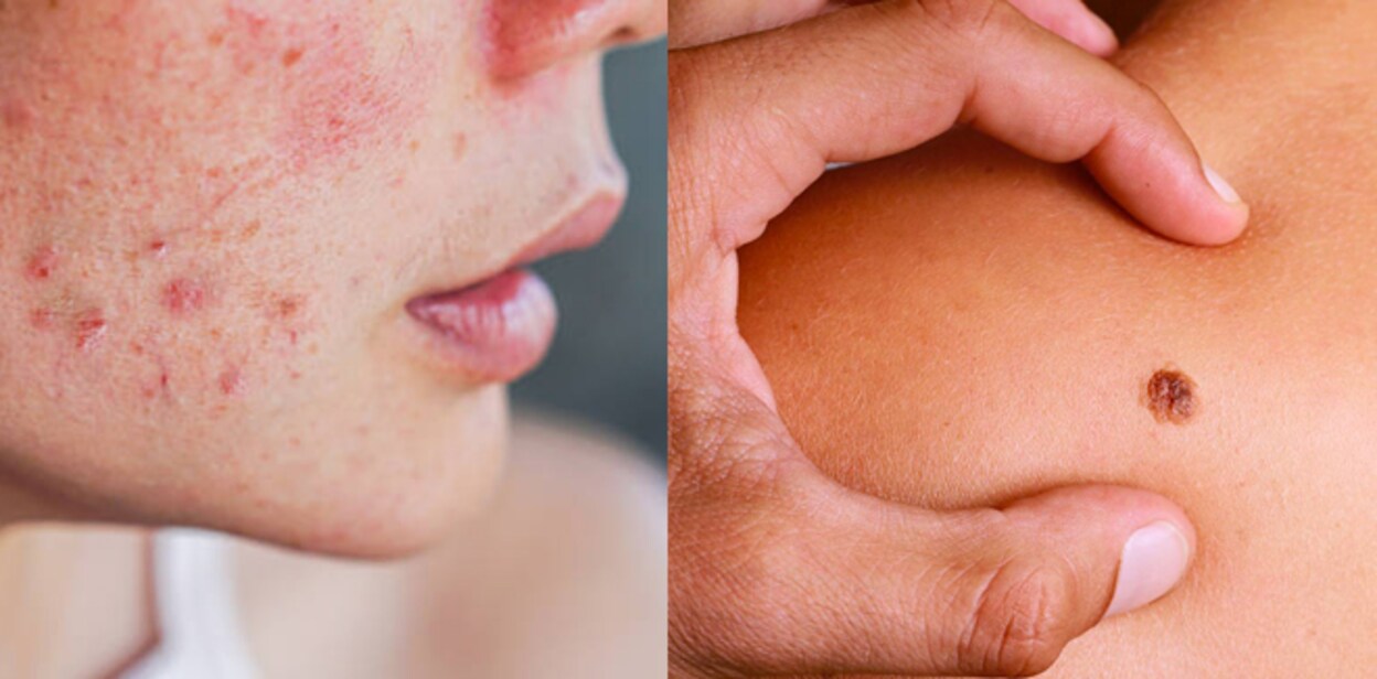 cancer-pimples
