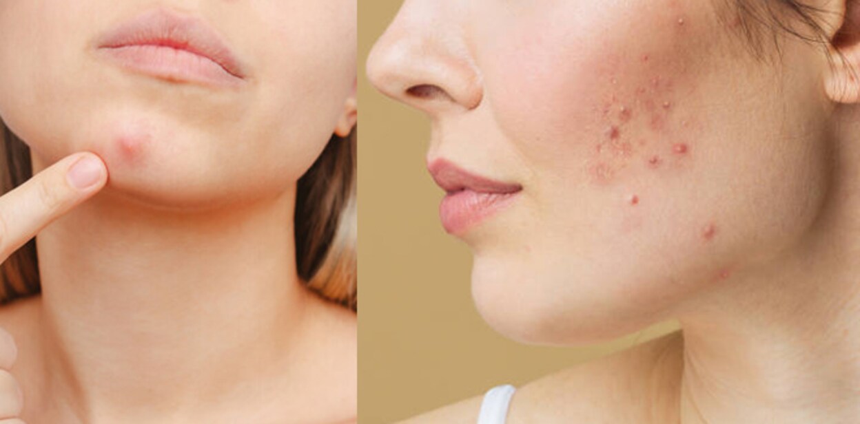 pimple-ccc56788
