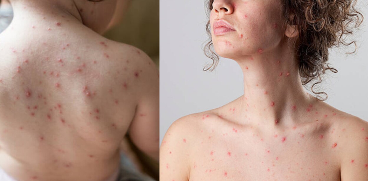 chickenpox4456767
