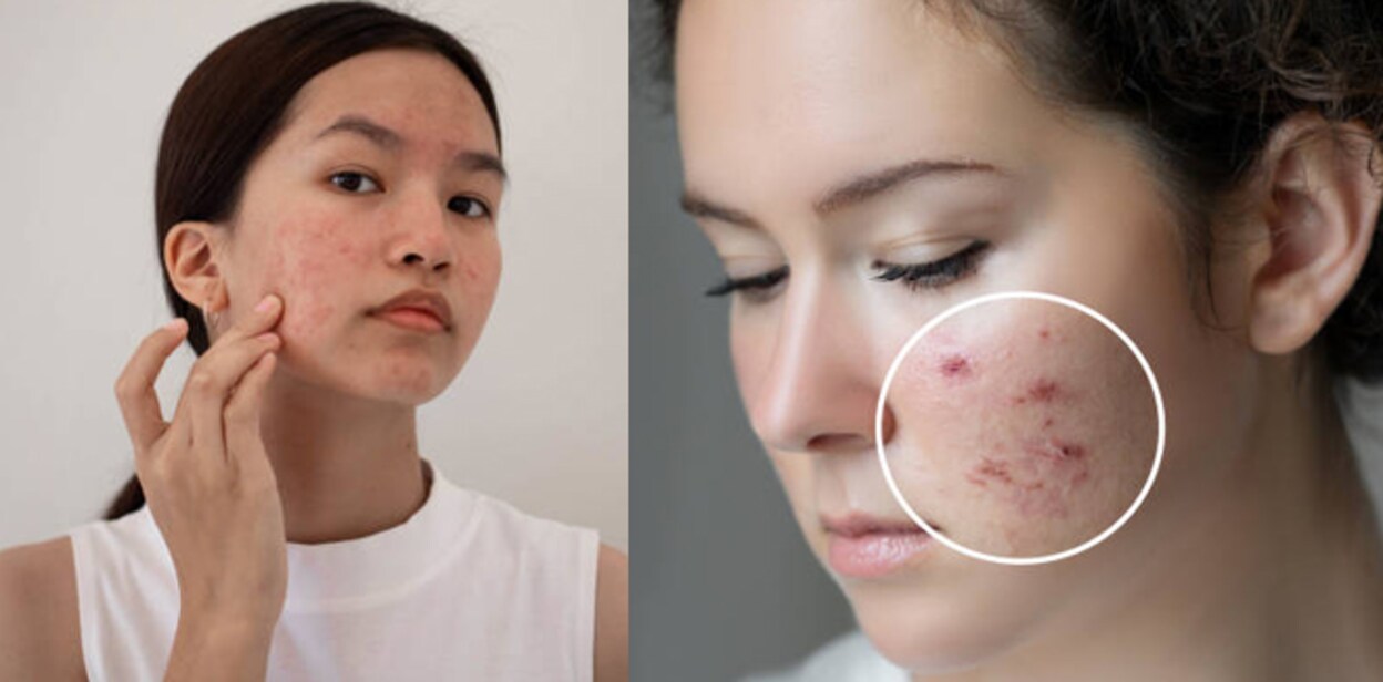 pimples-isyyyttt