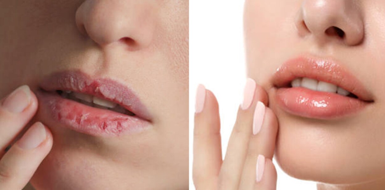 lips-dry-beauty-tips