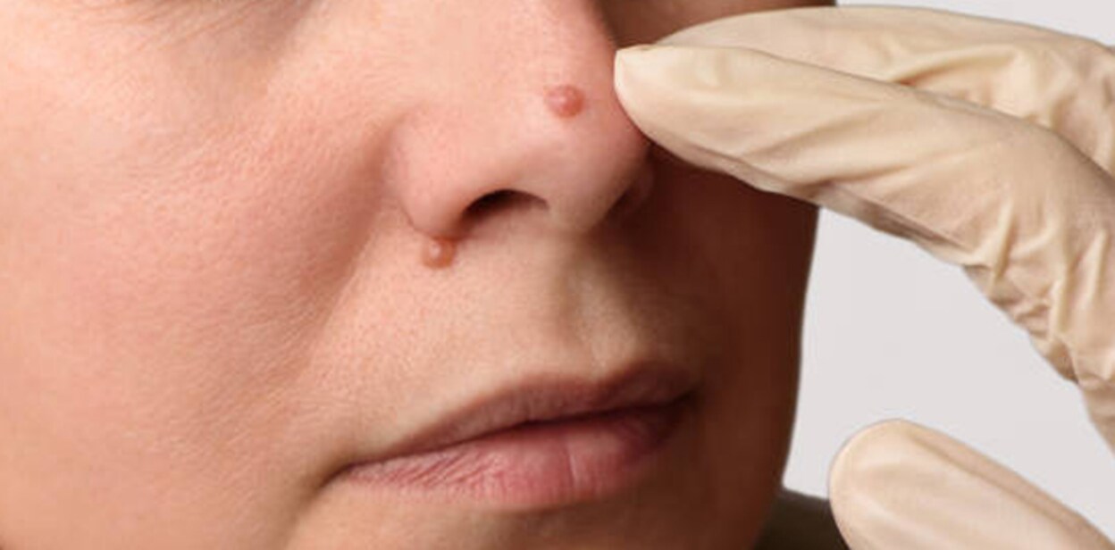 wart67787