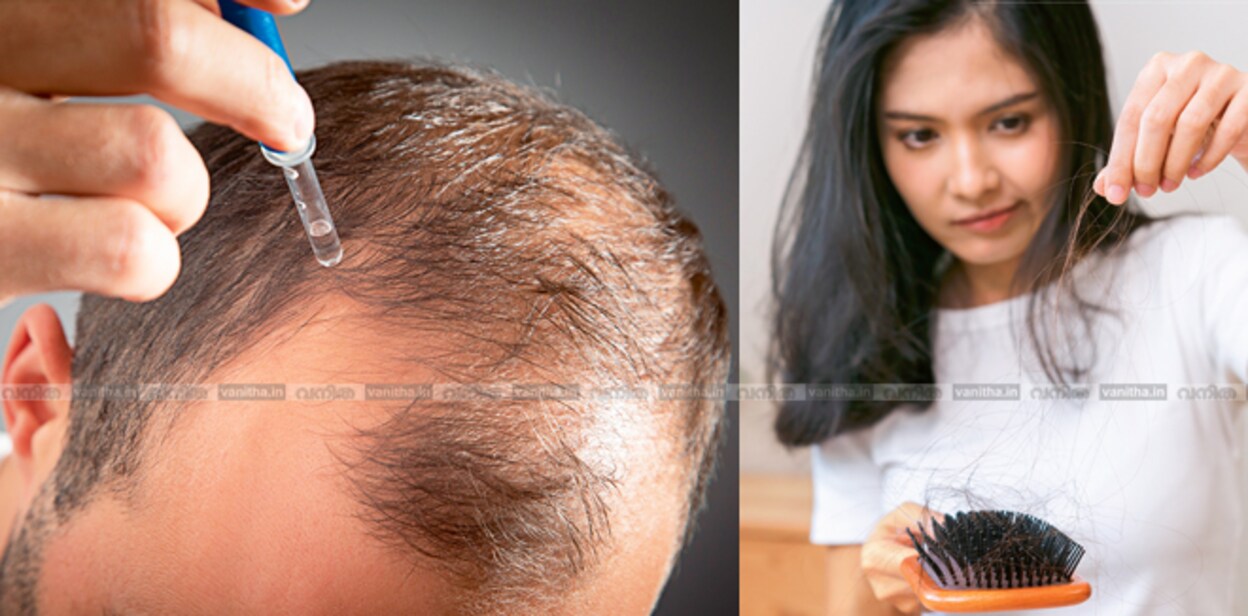 alopecia567