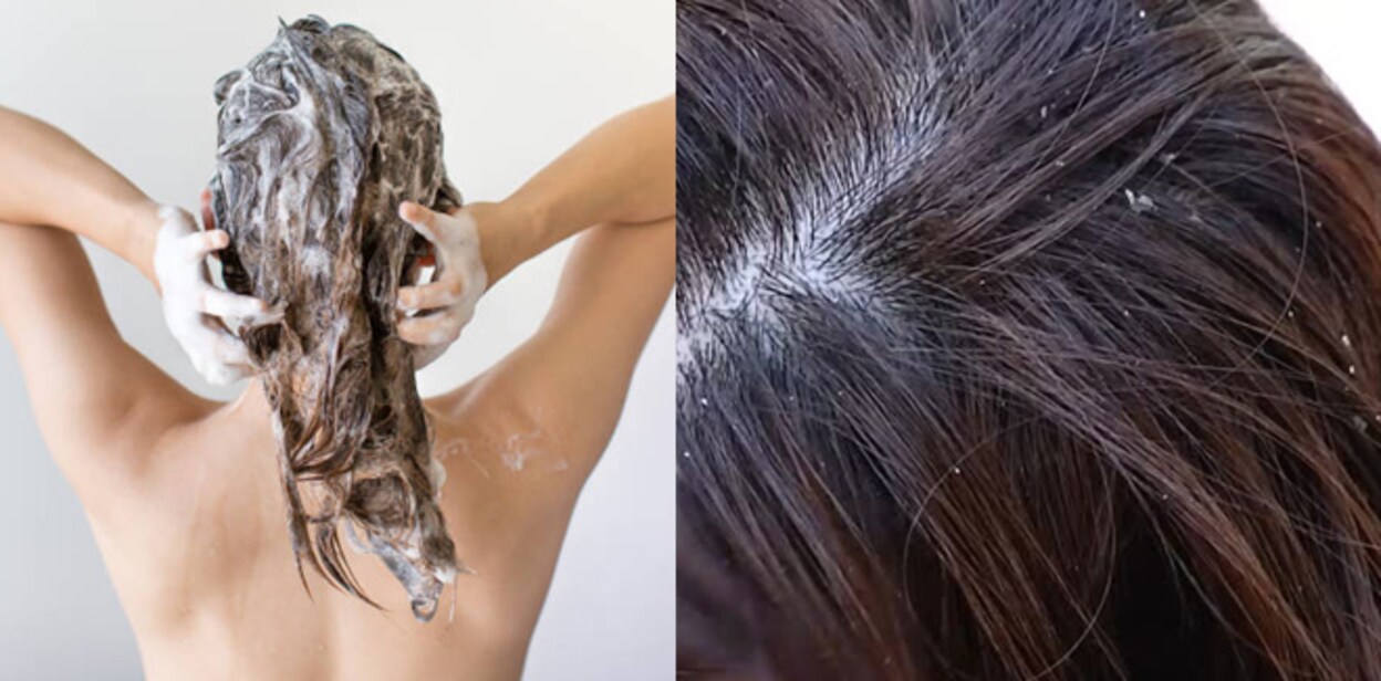 dandruff667jkk89