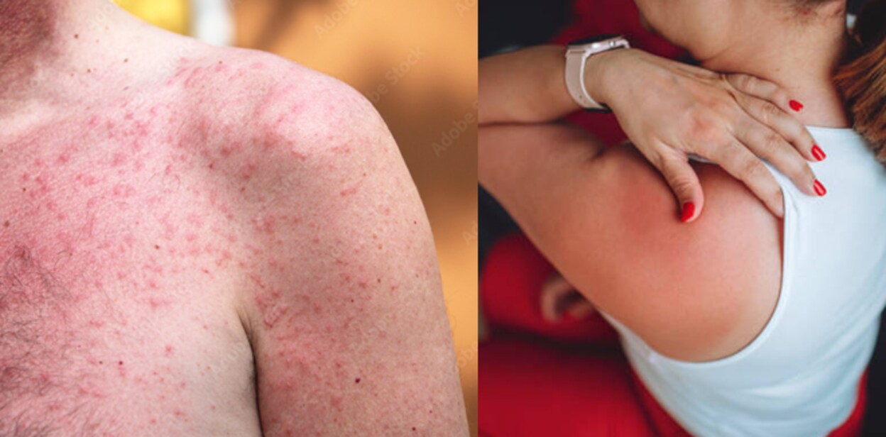sun-allergy6778