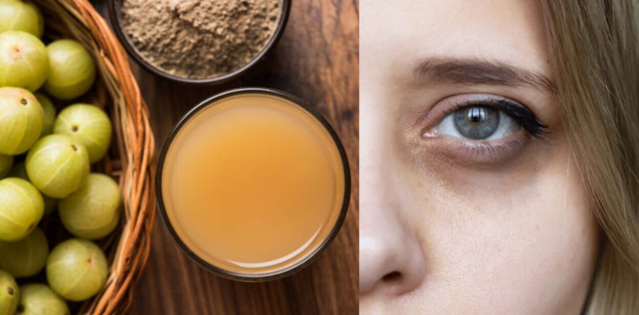 dark-circles-under-eyes