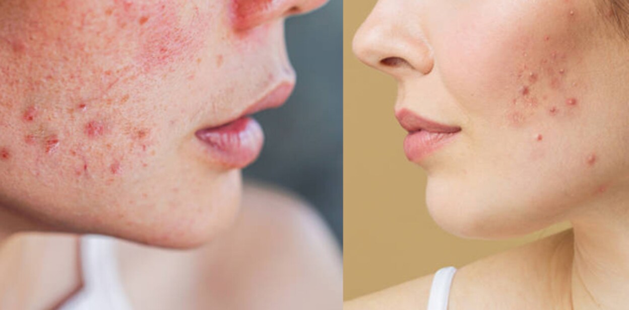 pimples456676ghhhcaree
