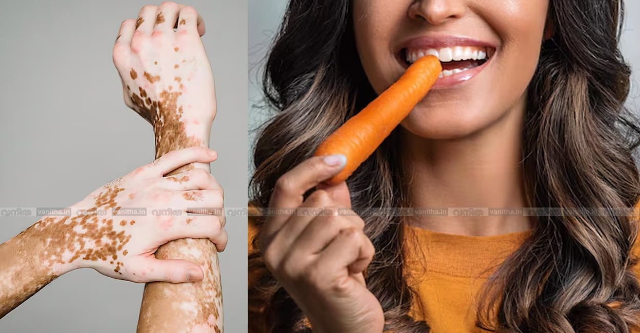 vitiligo-diet-plan-malayalam