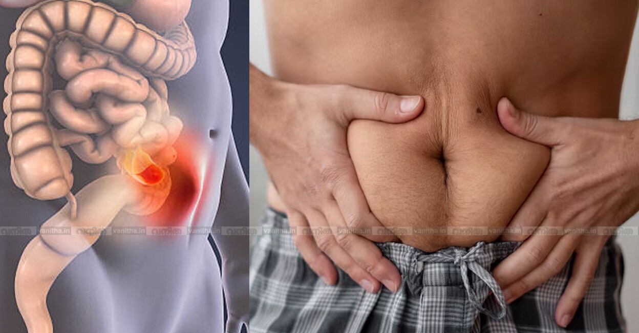 hernia-disease