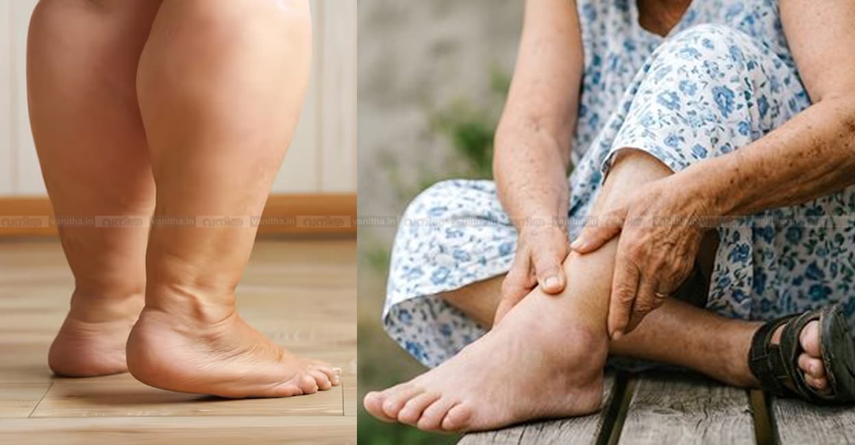 edema-in-legs-and-ankles