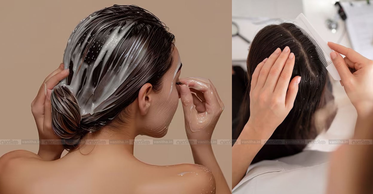 simple-ways-to-treat-dandruff-at-home