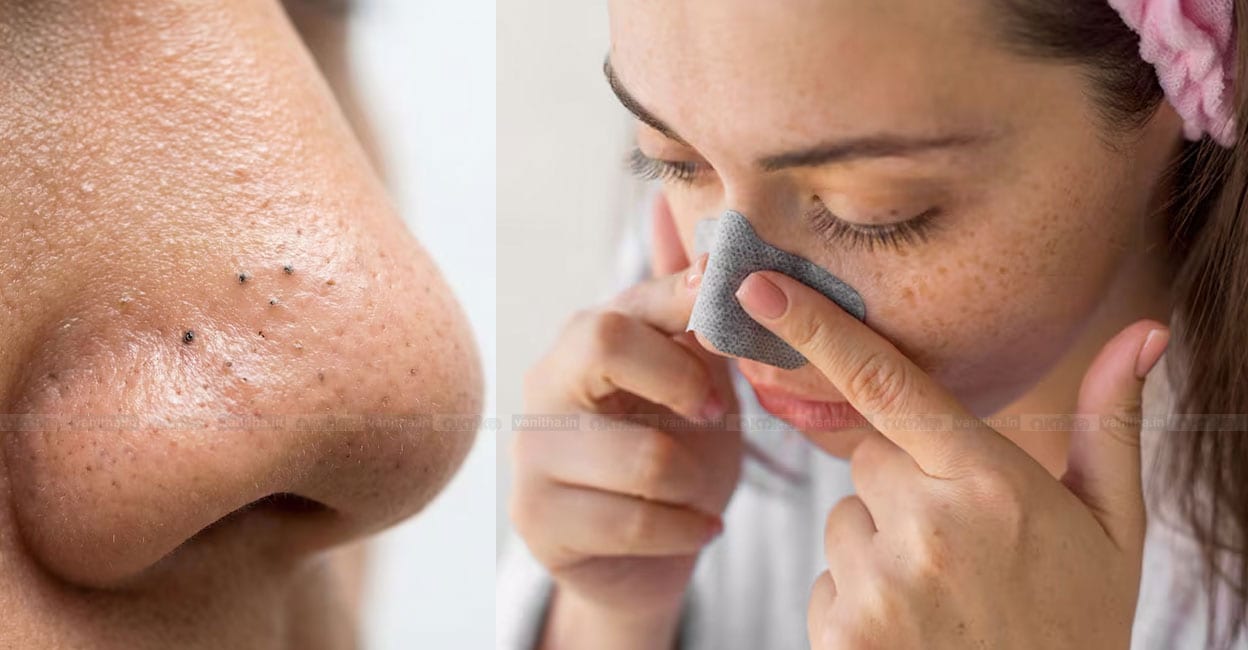 blackheads-nose