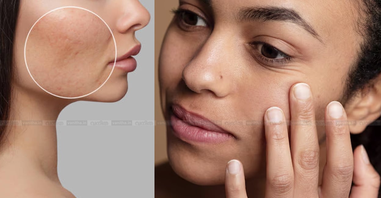 skin-pores-beauty-tips