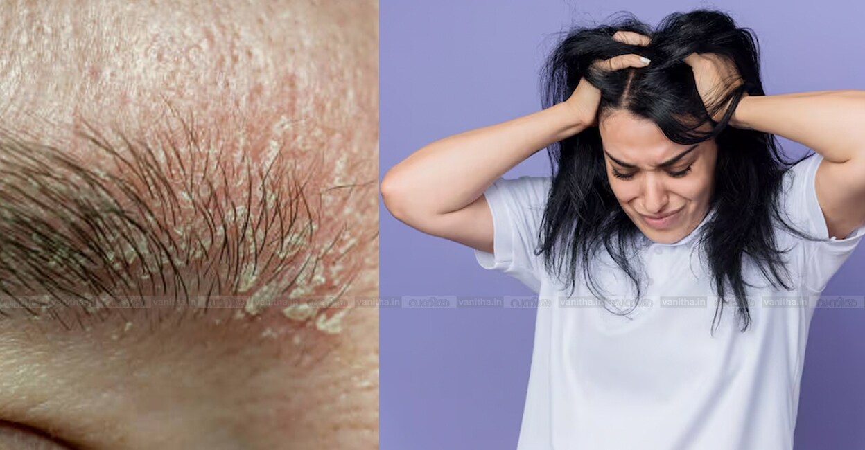 Natural-Remedies-for-Eyelash-and-Eyebrow-Dandruff