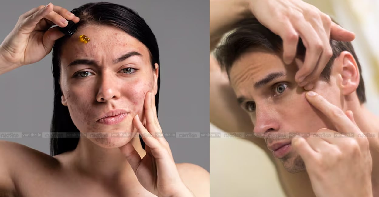 facial-acne-indicators-tell-health