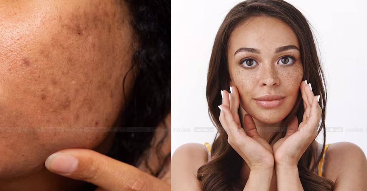 dark-spots-on-face