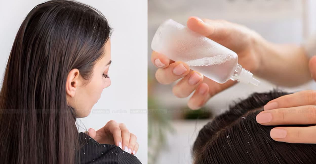 Effective-Home-Remedies-for-Dandruff