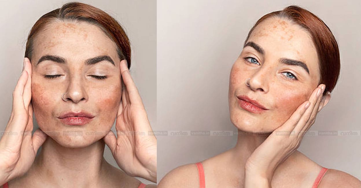 Melasma-treatment-tips