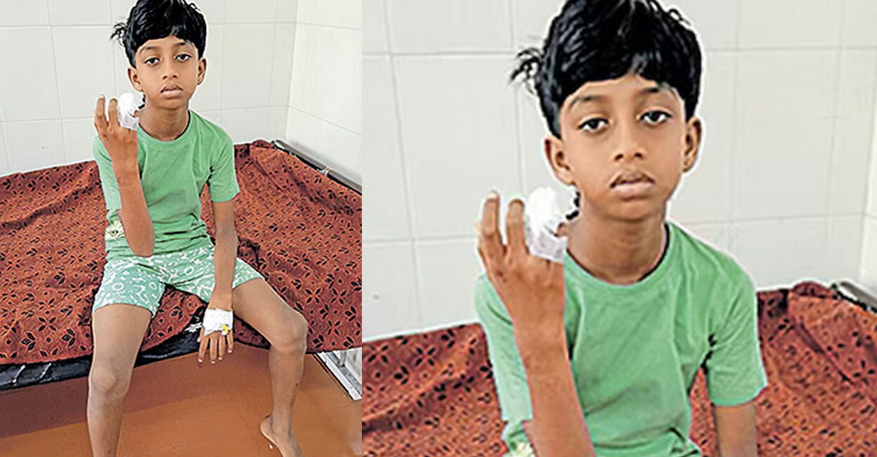 stray-dog-attacks-boy-loses-finger
