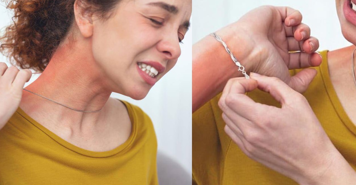 jewellery-allergy-common-symptoms