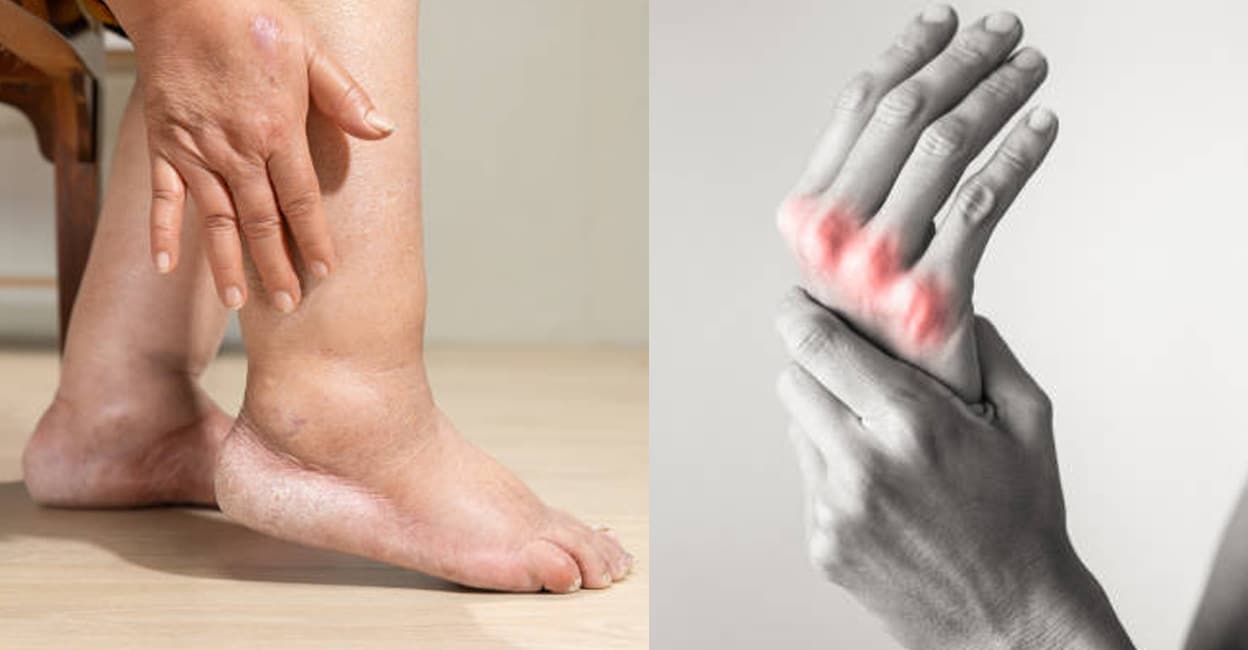 Early-Signs-of-Rheumatoid-Arthritis