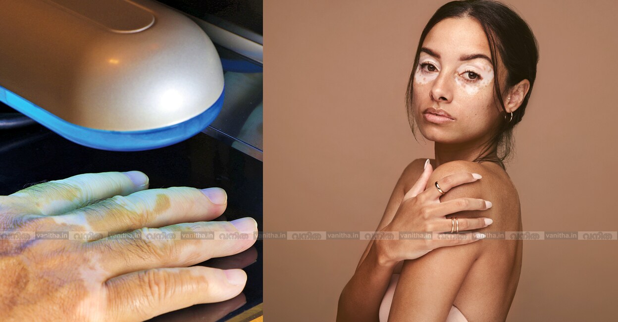 understanding-vitiligo-treatment-options