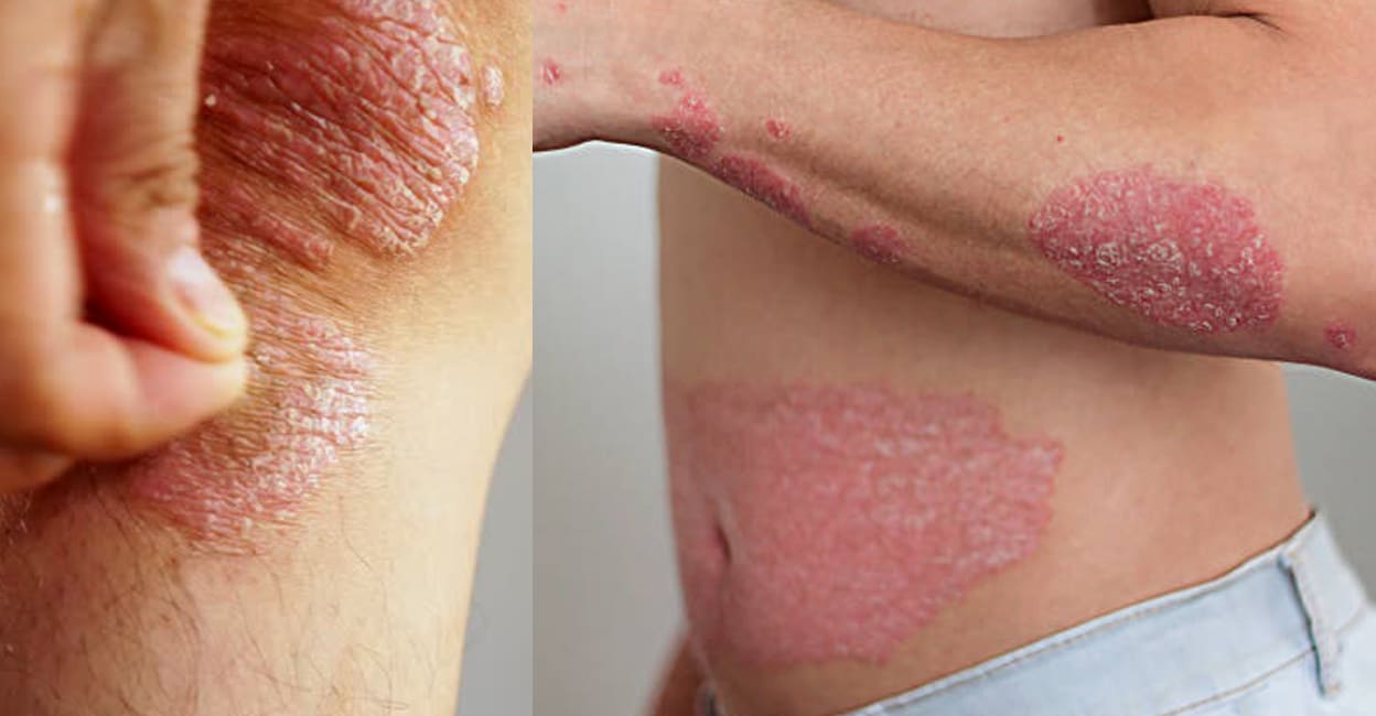 psoriasis-treatment