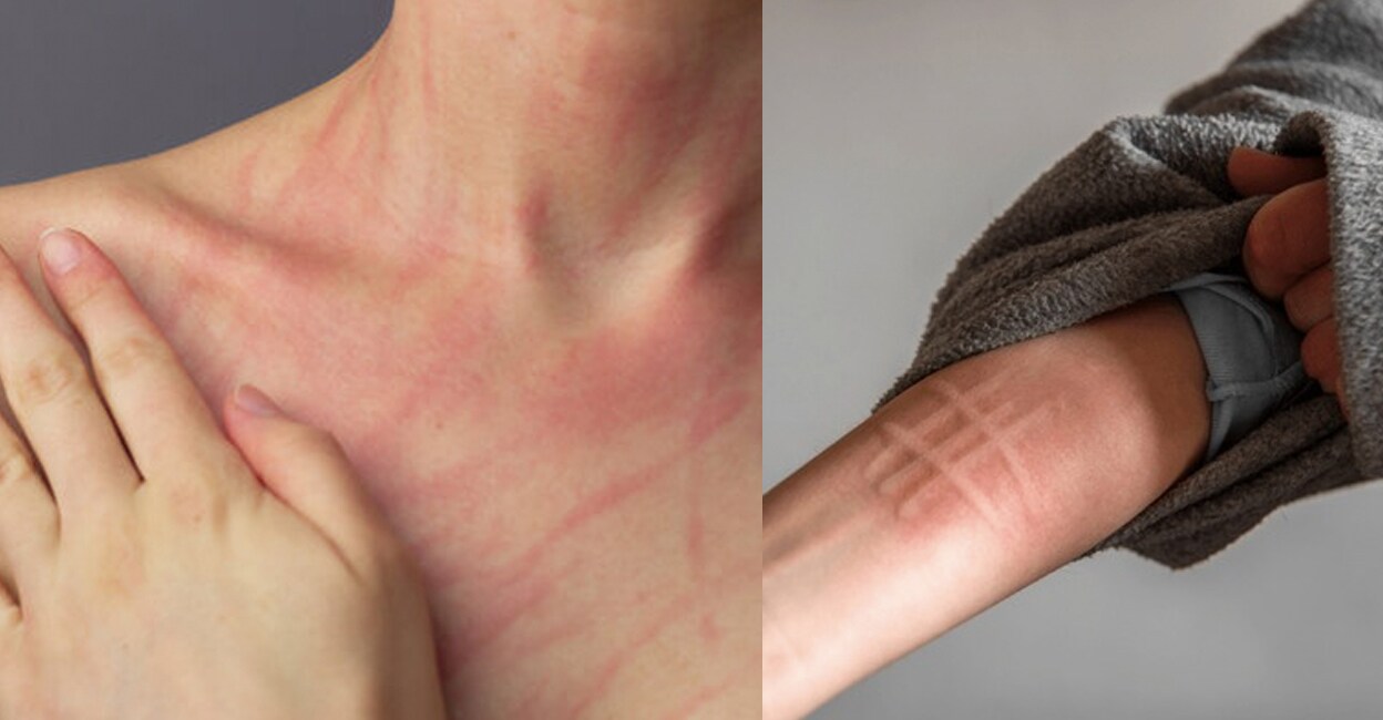 understanding-dermatographia-symptoms