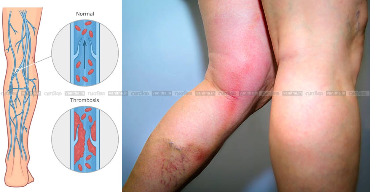 Deep-Vein-Thrombosis