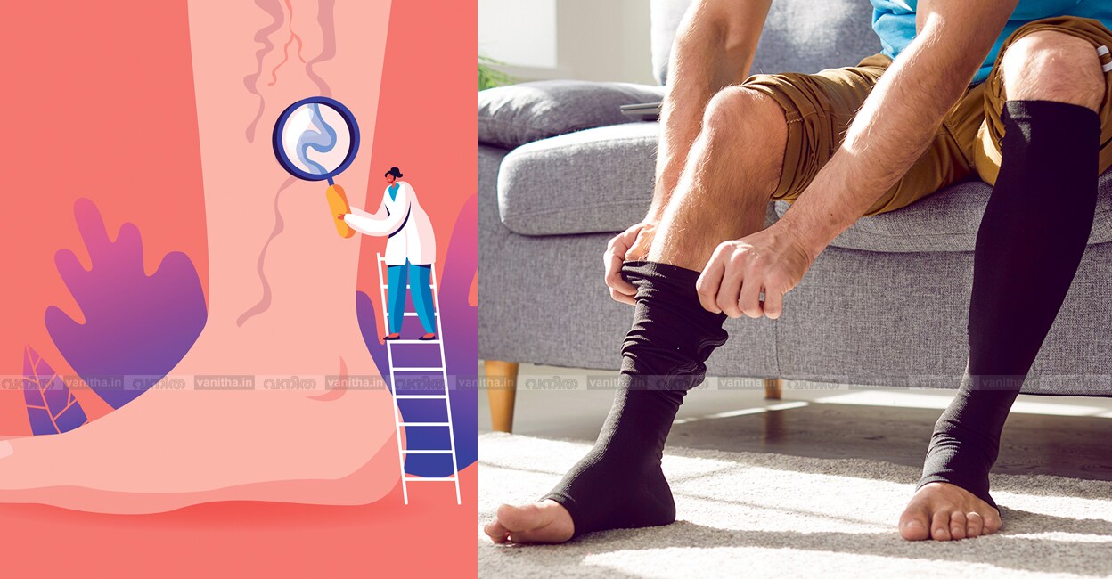 Understanding-Varicose-Veins