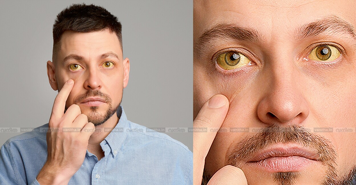 jaundice-causes-symptoms