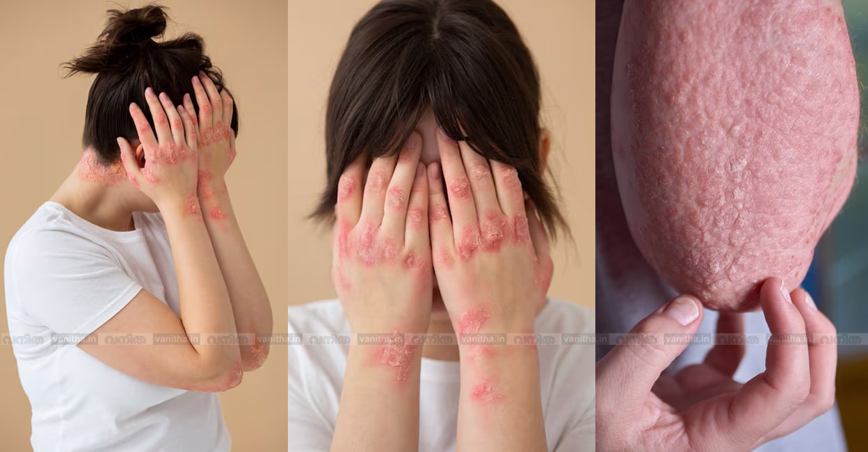 chicken-skin-strawberry-skin-keloid-skin-conditions