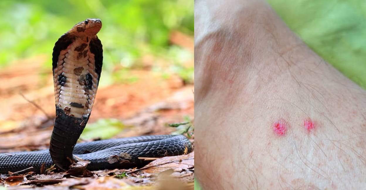 snake-bite-first-aid-treatment
